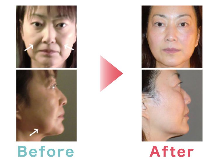 50代 フェイシャル